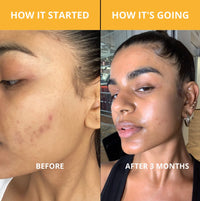 Nexora™ Peel Shot – Kojic + Turmeric Spray (200ml)